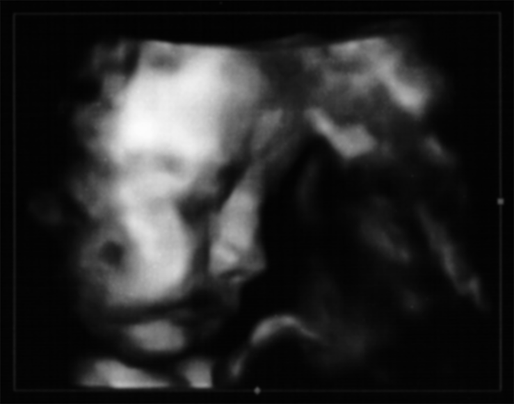 [3D Sonogram]